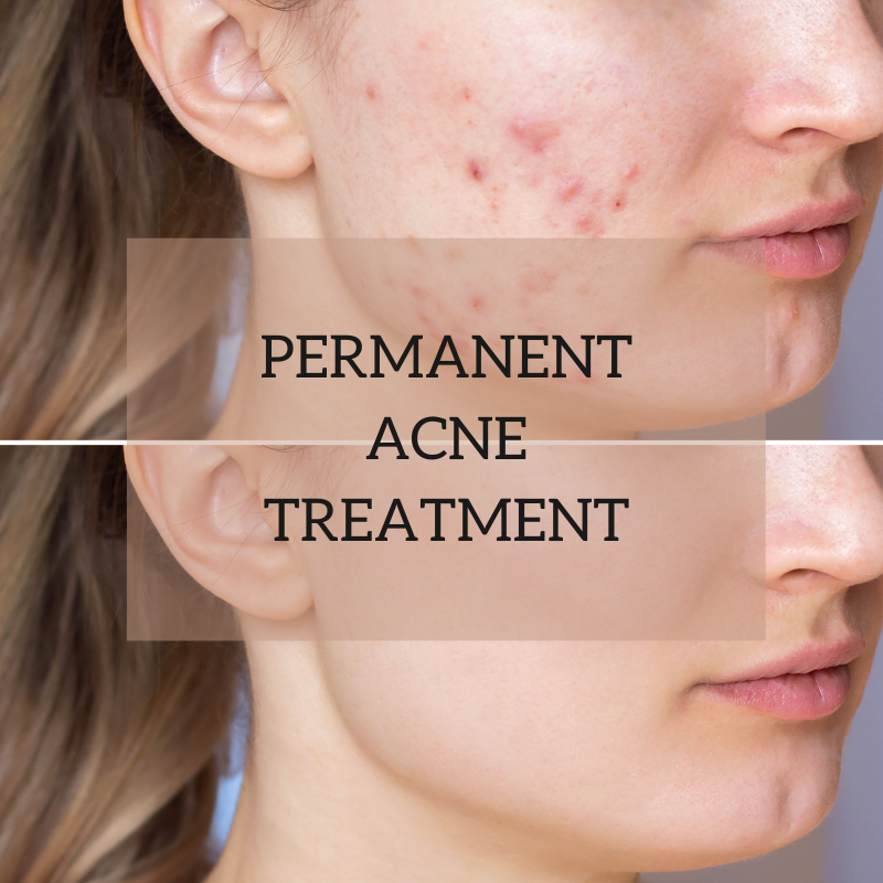 PERMANENT ACNE REMOVAL
